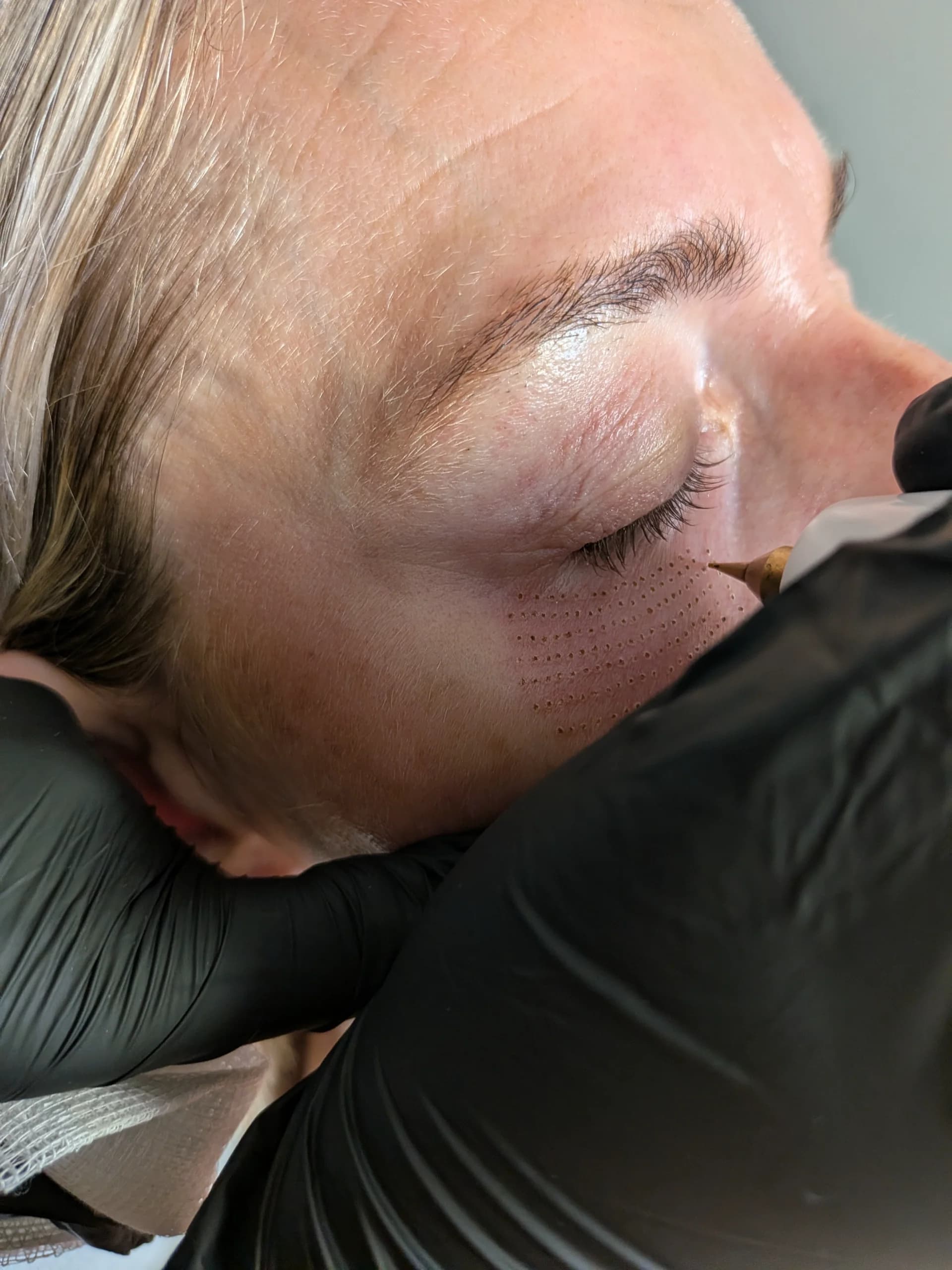 Plasma pen skin tightening